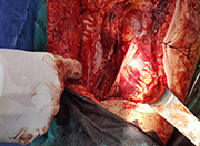 Sutura y reconstruccin de muslo