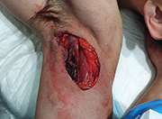 Cornada axila evento taurino quirfano